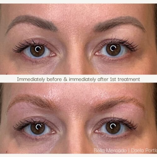 Laser PMU Removal at DAELA Scottsdale