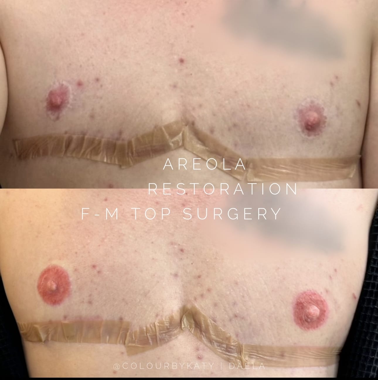 Gender Affirming Top Surgery Areola restoration at DAELA