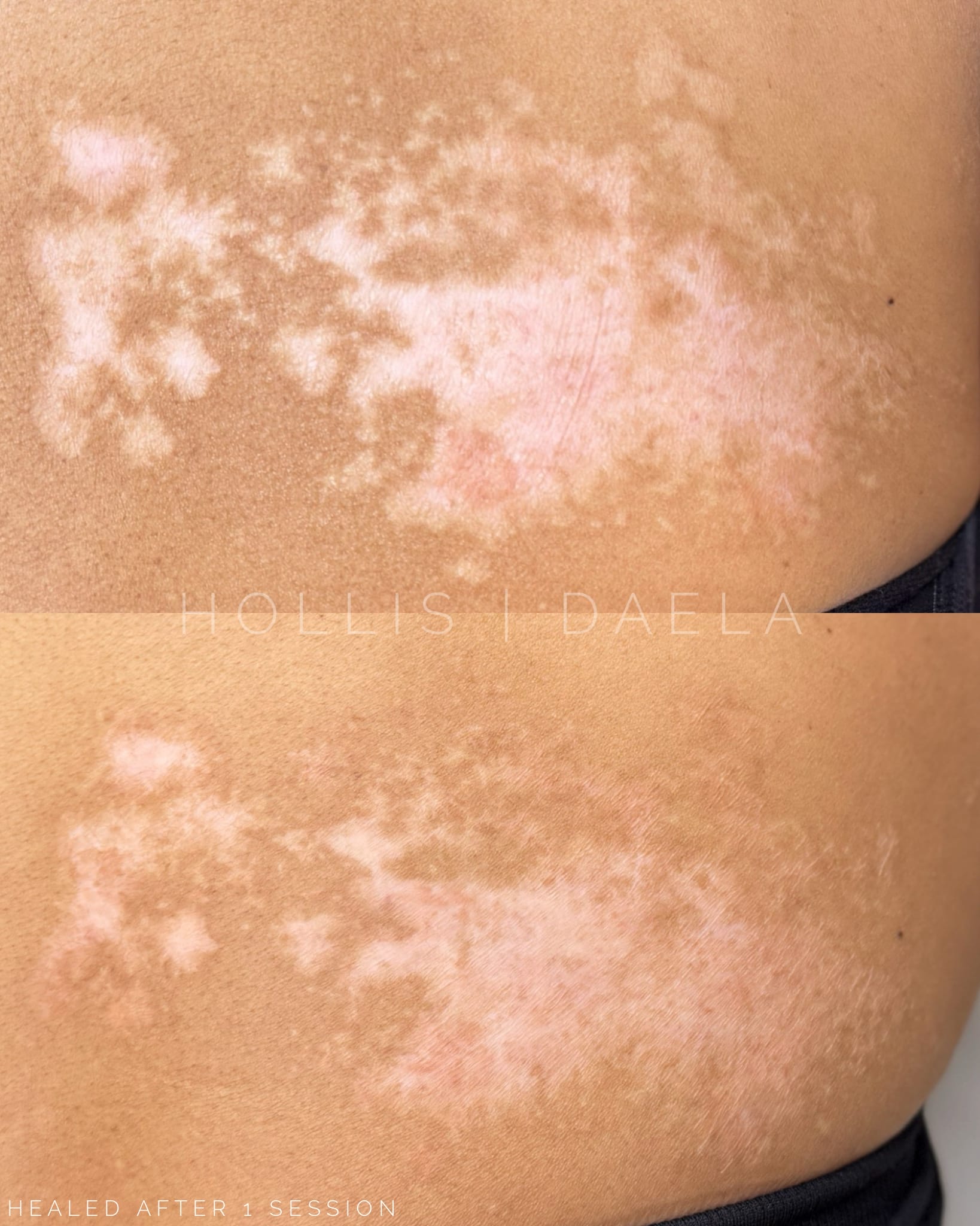 Scar-camouflage-tattoo-in-scottsdale Scar Camouflage tattoo in Scottsdale at DAELA Cosmetic Tattoo