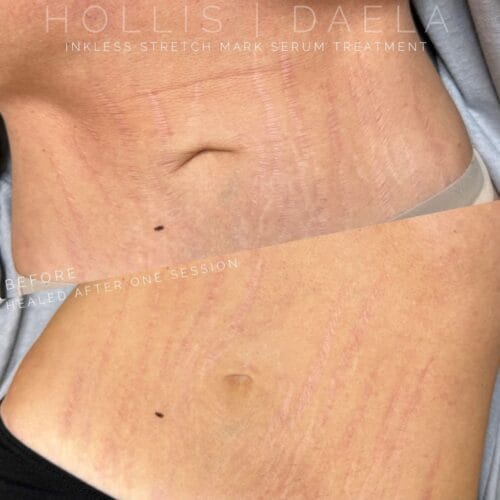 stretch mark camouflage in scottsdale at daela scottsdale