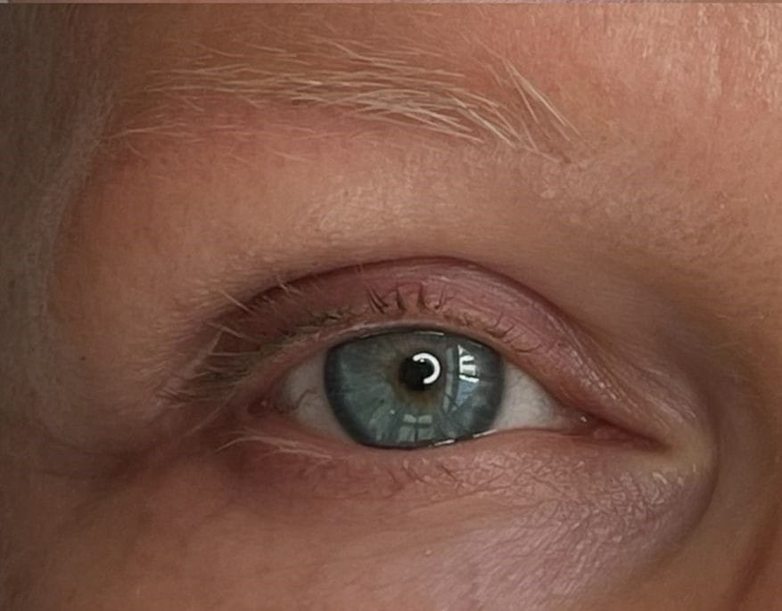 After permanent makeup removal