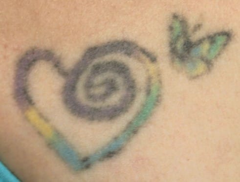 Before and After Laser tattoo Removal in Scottsdale