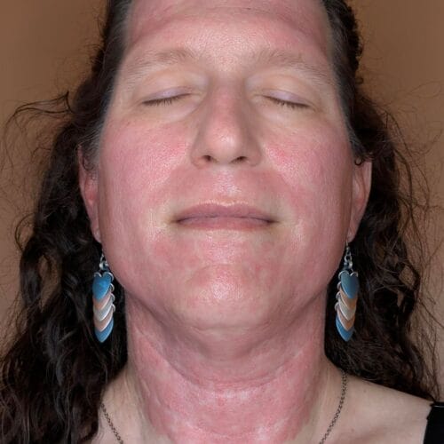 Immediately After a laser faceal in scottsdlae