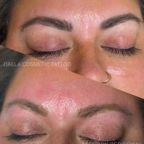 Laser Brow Tattoo Removal in Scottsdale