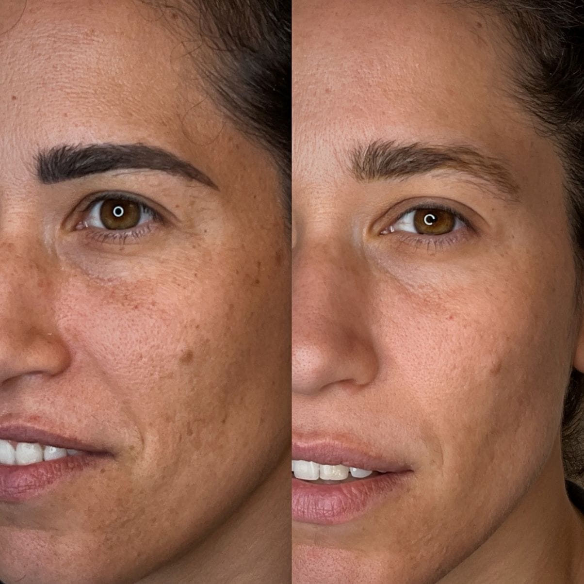 laser-skin-treatment-laser-brow-removal-scottsdale Laser Facials in Scottsdale
