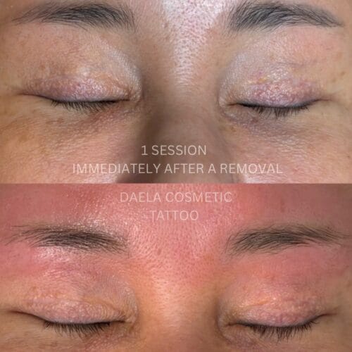 Laser PMU Removal DAELA Cosmetic Tattoo