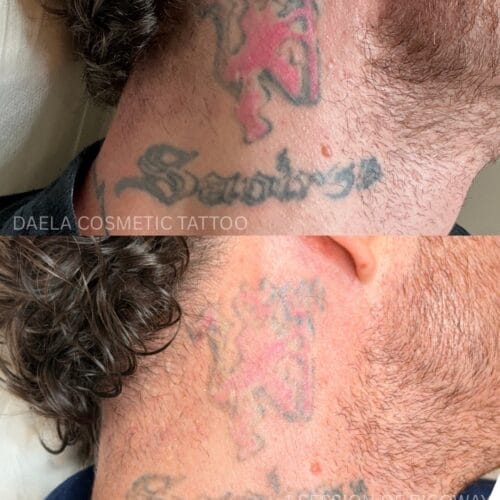 Tattoo Removal Progress at DAELA