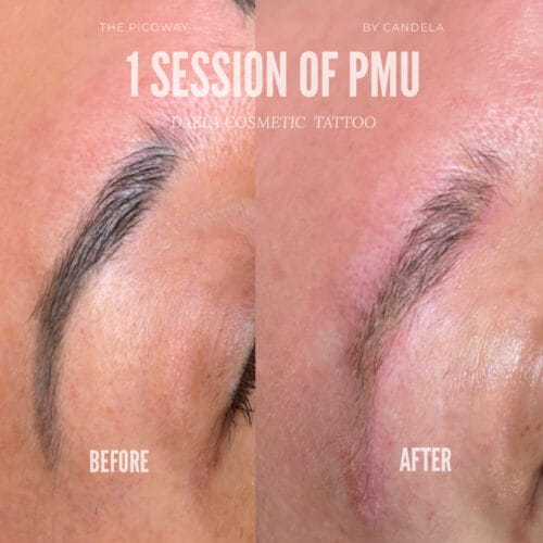 PMU Removal with Pico Way at DAELA