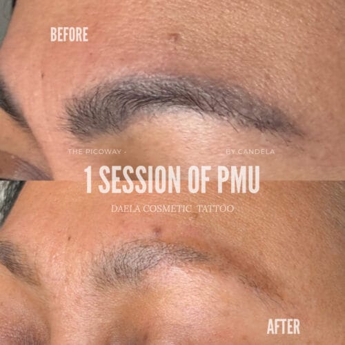 PMU Removal at DAELA with Pico Way