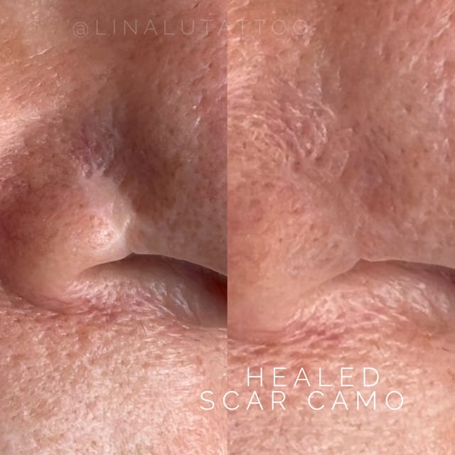 Scar Camouflage Tattoo in Scottsdale at DAELA