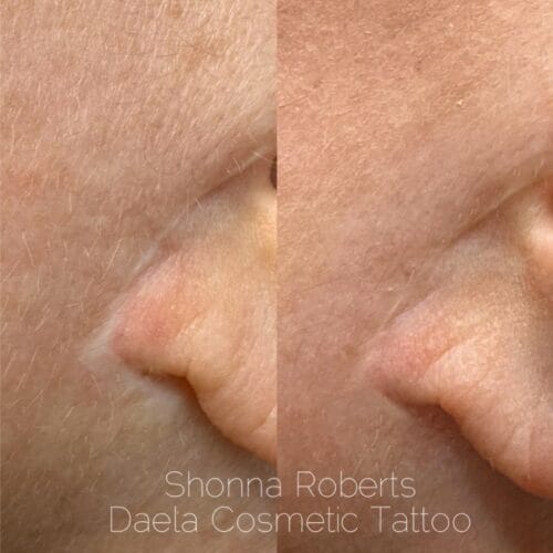 scar-camouflage-tattoo-in-scottsdale-at-daela-cosmetic-tattoo