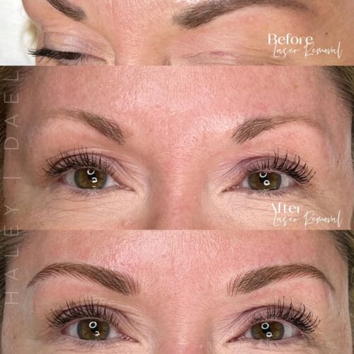 Laser PMU Removal at DAELA