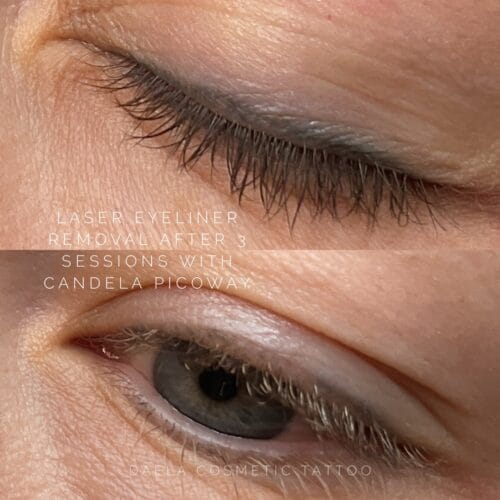Laser Eyeliner Tattoo Removal at DAELA