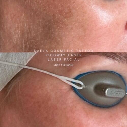 Laser brown spot removal at DAELA