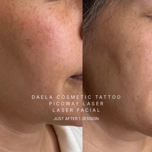 Laser brown spot removal at DAELA