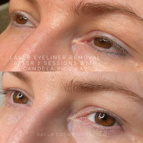 Laser Eyeliner Tattoo Removal at DAELA
