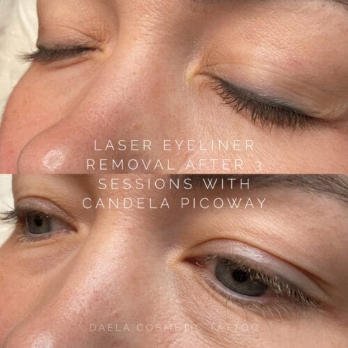 Laser Eyeliner Tattoo Removal at DAELA