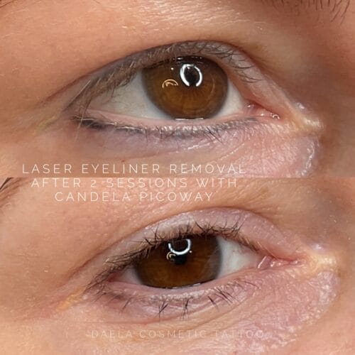 Laser Eyeliner Tattoo Removal at DAELA