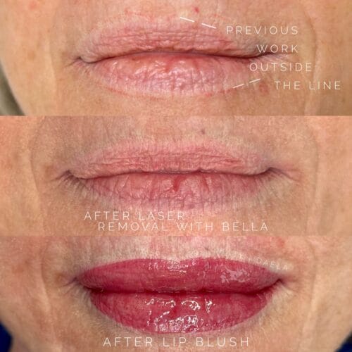 laser lip blush removal