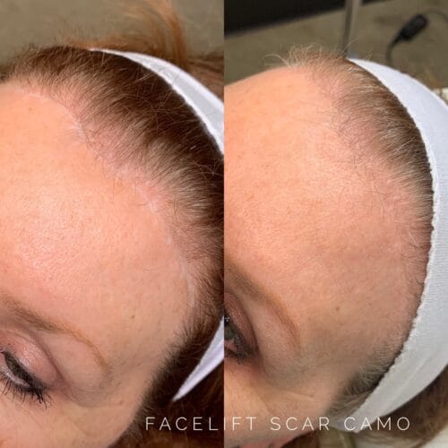Scar Camouflage Tattoo at DAELA Scottsdale