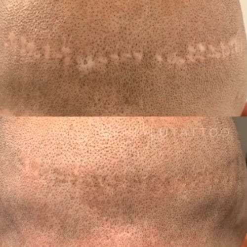 Scar Camouflage Tattoo at DAELA Scottsdale