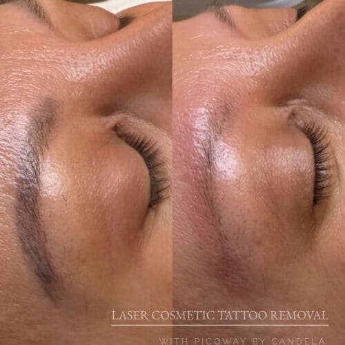 Laser PMU Removal DAELA Scottsdale