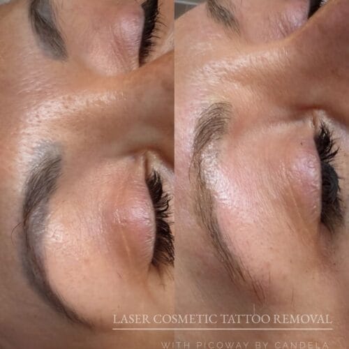 Laser PMU Removal DAELA Scottsdale