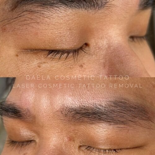 Laser PMU Removal DAELA Scottsdale