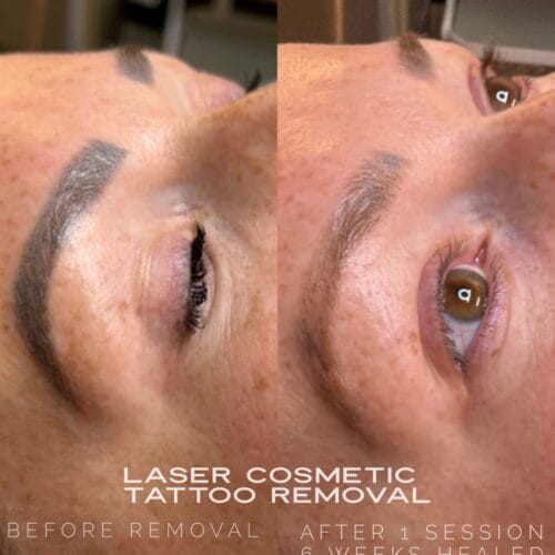 Laser PMU Removal DAELA Scottsdale