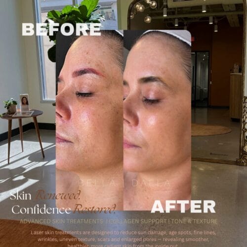 Laser Skin Rejuvenation at DAELA