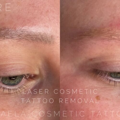 Laser PMU Removal DAELA Scottsdale