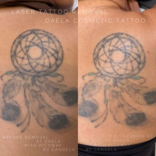 laser tattoo removal at daela scottsdale