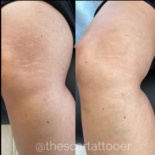 Stretch mark camouflage in scottsdale at daela