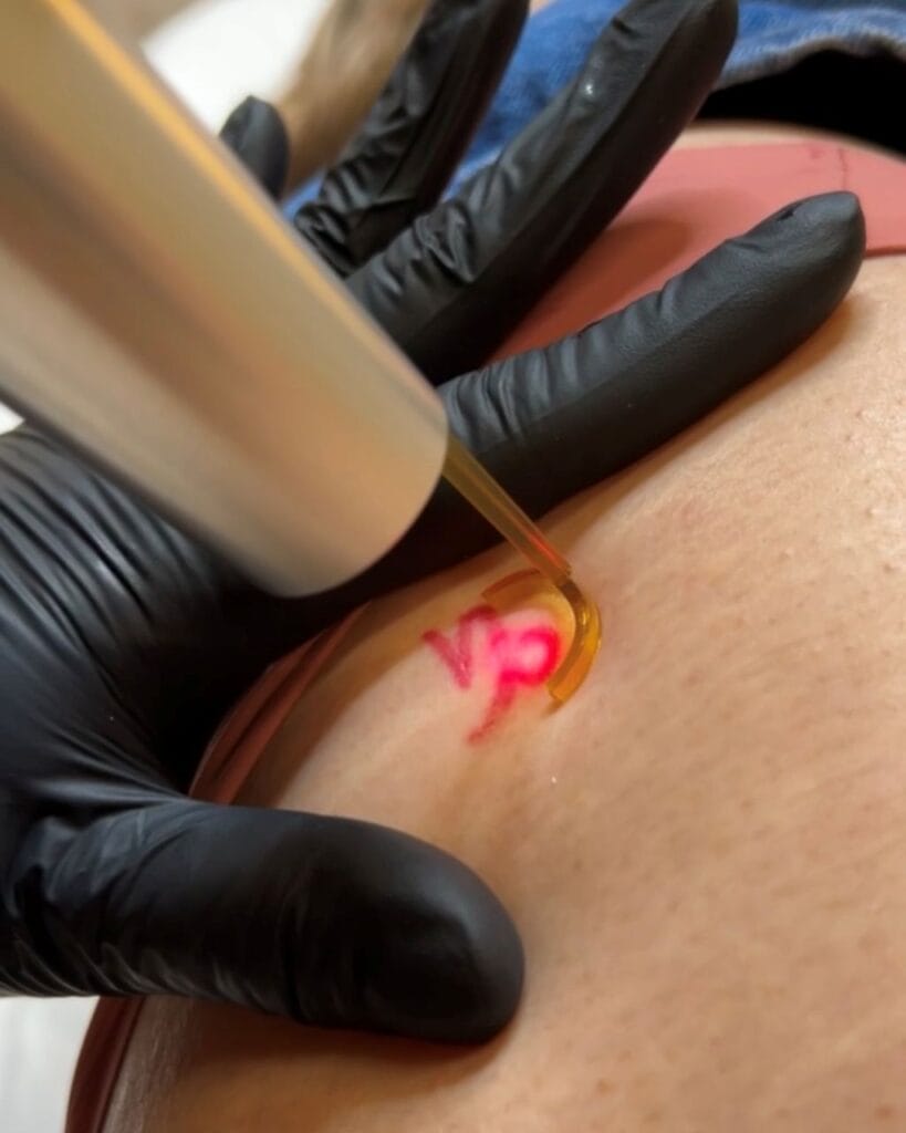 Laser tattoo Removal DAELA Scottsdale