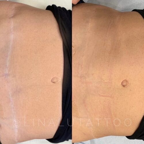 Scar Camouflage Tattoo at DAELA Scottsdale