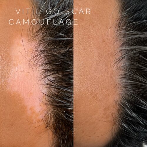 Scar Camouflage Tattoo at DAELA Scottsdale