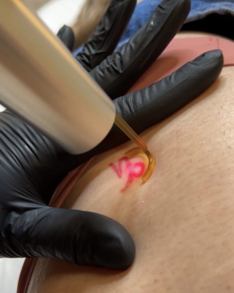 laser tattoo removal daela scottsdale
