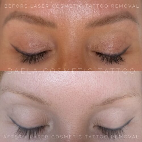 Laser PMU Removal at DAELA Scottsdale