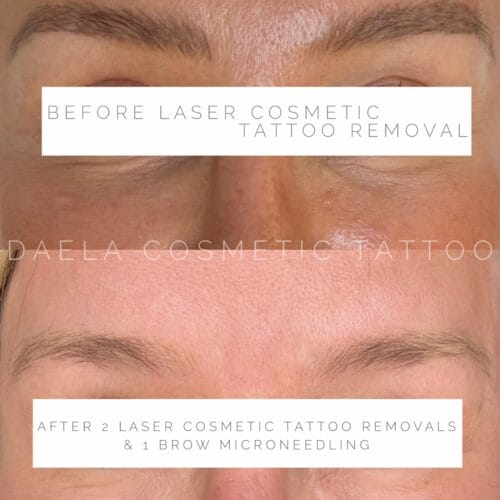 Laser PMU Removal at DAELA Scottsdale