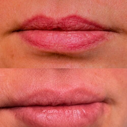 Laser PMU Removal at DAELA Scottsdale