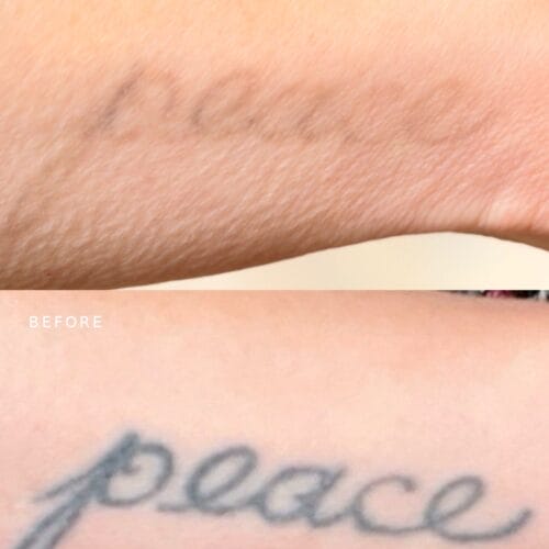 Laser tattoo Removal at DAELA Scottsdale