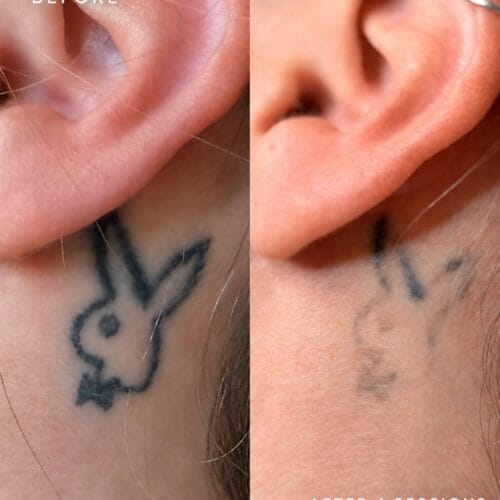 Laser tattoo Removal at DAELA Scottsdale