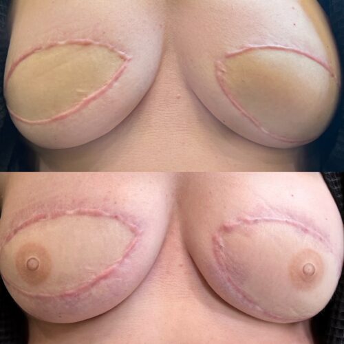 Areola Restoration Tattoo Vancouver DAELA Lina