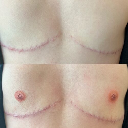Areola Restoration Tattoo Vancouver DAELA Lina