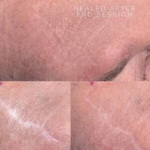 Scar Camouflage Tattoo at DAELA Cosmetic Tattoo