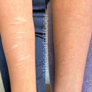 Can you cover up a scar with a tattoo? by DAELA Cosmetic Tattoo