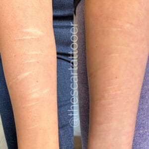 Scars: Amazing Ways to Cover Up a Scar with a Tattoo!