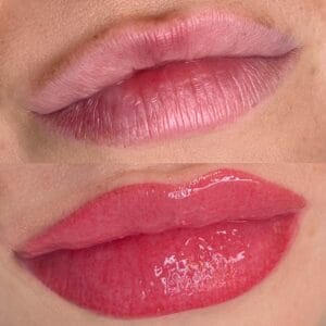 Should I get lip blush before or after fillers?