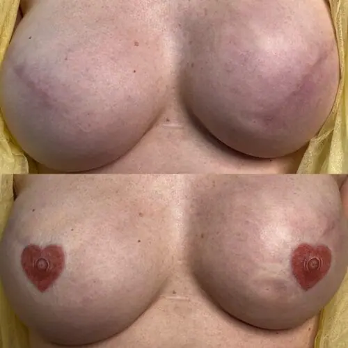 Areola Restoration Training at DAELA Academy