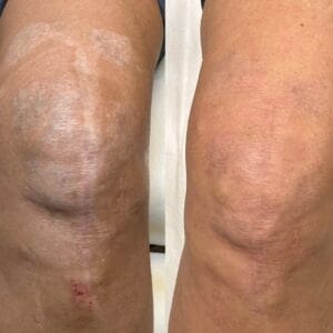 Scar Camouflage on Knees